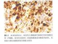 淋巴瘤常用标记物详解-T、B以外的细胞图12