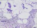 乳腺肿块，切面弥漫散在囊腔，内容胶冻样物图7
