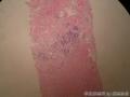 女，40岁，右乳腺穿刺活检图2