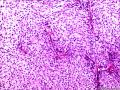 是什么？腺泡状软组织肉瘤？Ｐｃｏｍａ?副神经节瘤？图7
