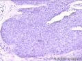 皮肤增生物图16