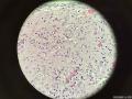 孔祥田老师病例讨论F28  cervical biopsy已点评图3