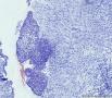 子宫粘膜下平滑肌瘤图11