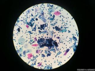 宫颈赘生物，术前TCT图10