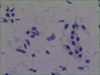 hpv16阳性图5