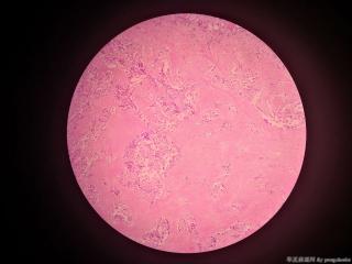 求教各位老师，这个甲状腺是什么癌？图21
