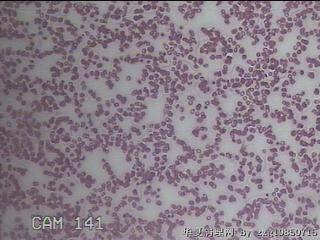 甲状腺穿刺液图26