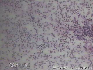 甲状腺穿刺液图3