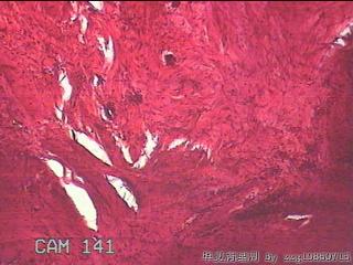 左足趾皮肤赘生物图17
