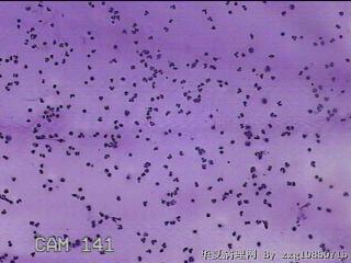 膝关节腔积液12ml图23