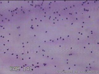 膝关节腔积液12ml图31