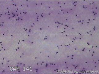 膝关节腔积液12ml图23