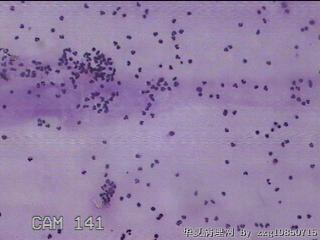 膝关节腔积液12ml图28