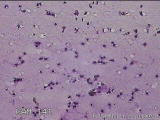 膝关节腔积液12ml图25