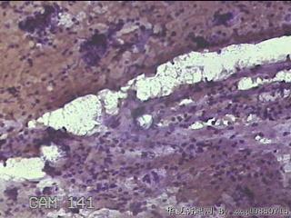 左侧甲状腺细针穿刺涂片图23
