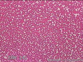 甲状腺细针穿刺涂片图32
