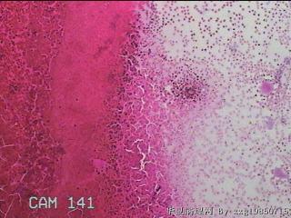 甲状腺细针穿刺涂片图1