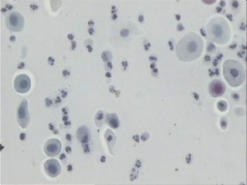 宫颈刮片．７２宫颈赘生物三个有蒂，黄带腥臭一年．图7