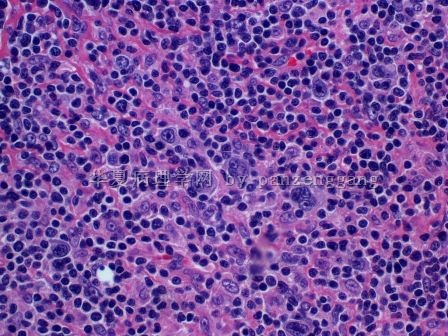Lymphadenopathy图6